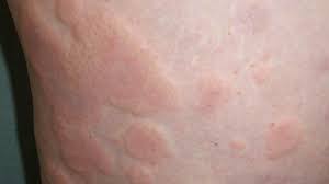 Cold urticaria what is it and how to cure it
