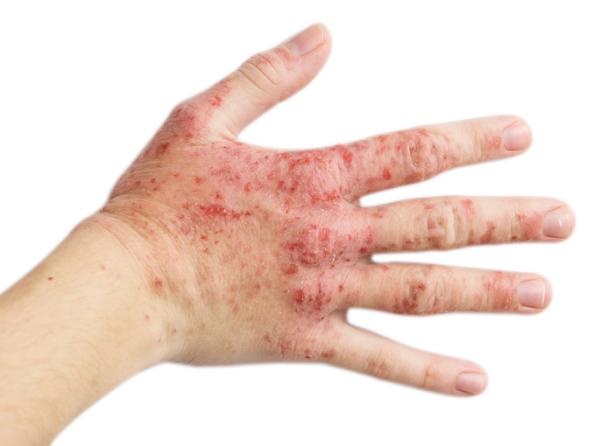 Guttate psoriasis causes and natural treatment