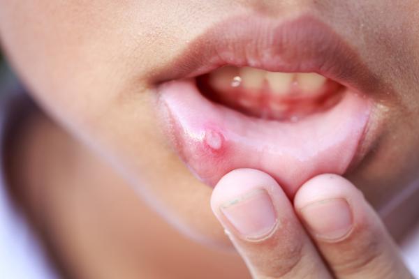 Home remedies for mouth sores