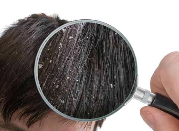 Home remedies for scalp scaling