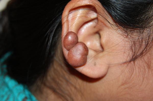 How to cure a keloid in the piercing