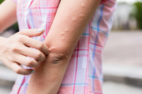 How to reduce the inflammation of a mosquito bite