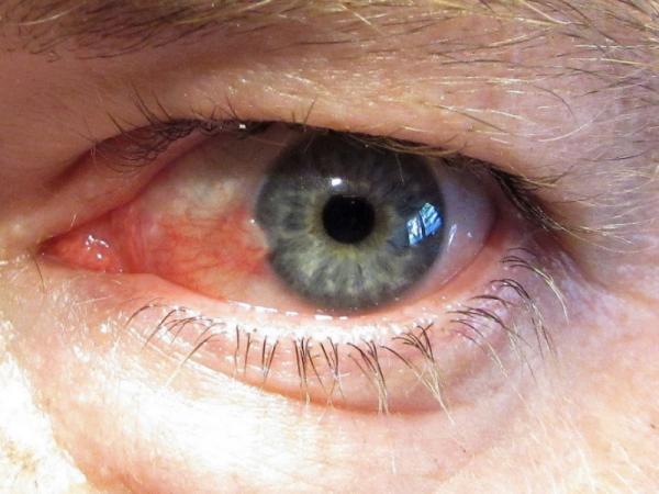 How to remove pterygium without surgery