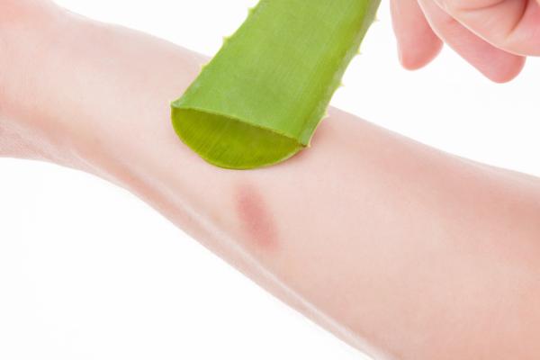 How to use aloe vera for burns
