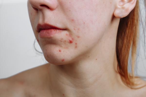 How to use salicylic acid for acne