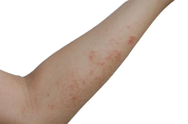 How to use white vinegar for scabies