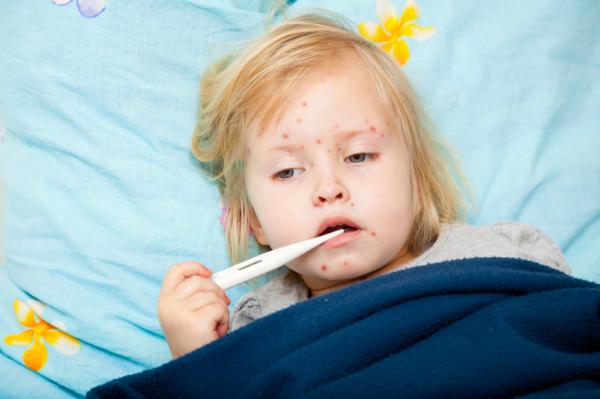 Koplik spots and measles causes and treatment