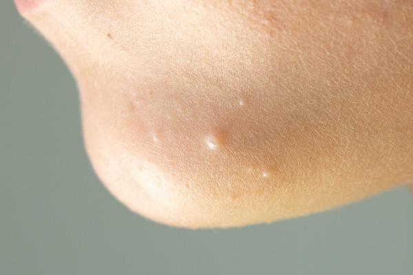 What are mollusks on the skin and how to remove them