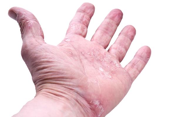 home remedies for psoriasis on hands