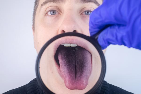 Black spots on the tongue why they come out and how to remove them