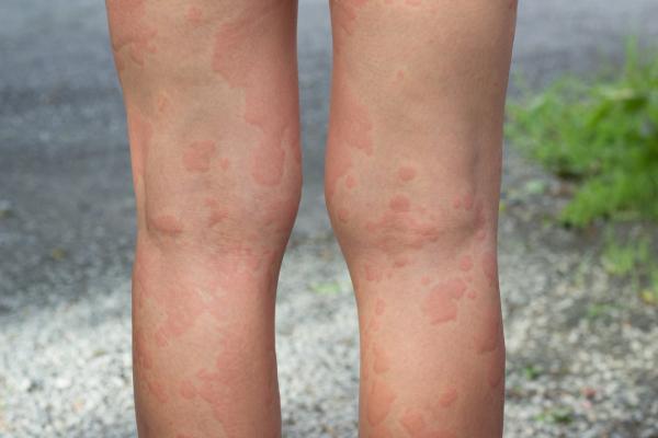 Cold urticaria: what it is and how to cure it