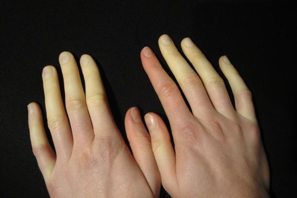 Home Remedies for Raynaud's Disease
