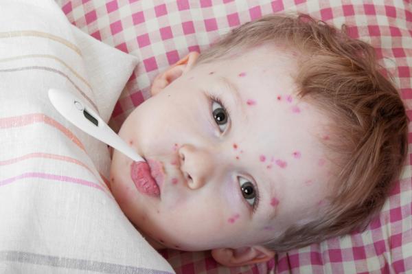 How Chickenpox Is Spread in Babies