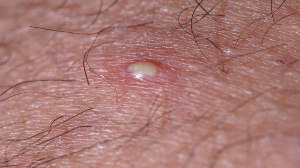 How to cure an infected ingrown hair