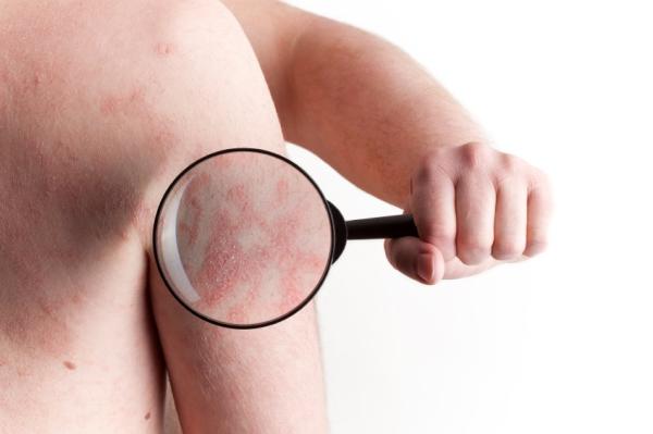 How to cure nervous psoriasis