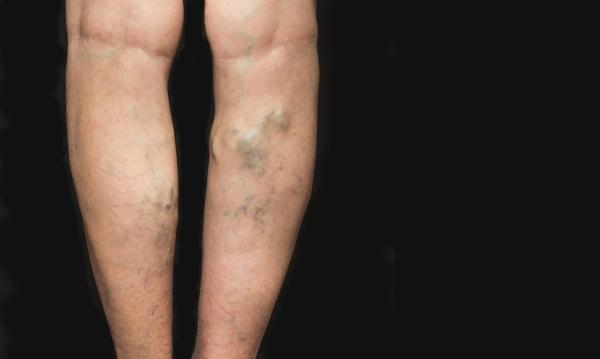 How to cure varicose veins with olive oil