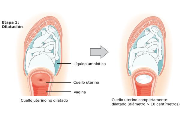 How to dilate faster in childbirth