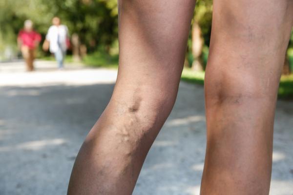 How to eliminate varicose veins with coconut oil - effective remedy