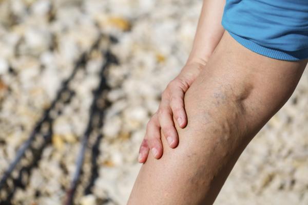 How to remove thick varicose veins