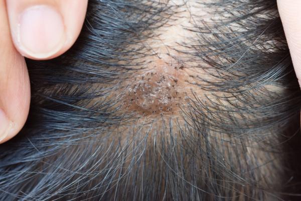 How to remove warts on the head - the best solutions.