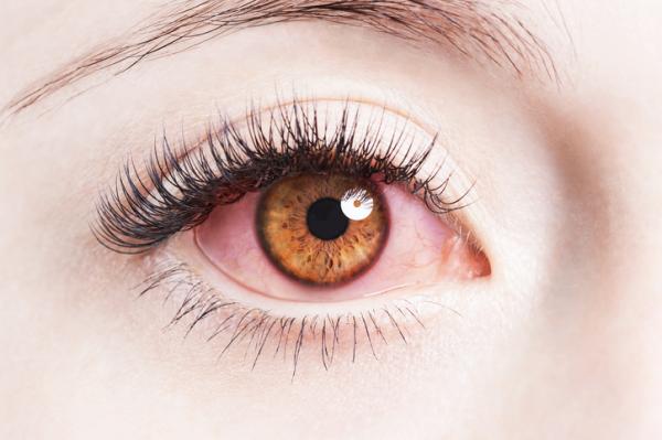 Natural treatment for ocular rosacea