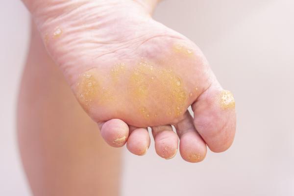 Why I have yellow feet