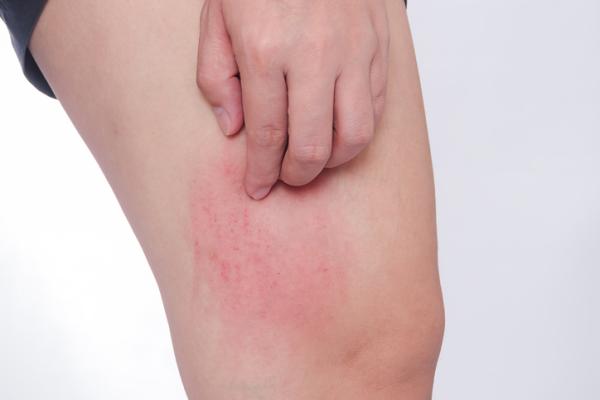 Why my legs itch at night - find out