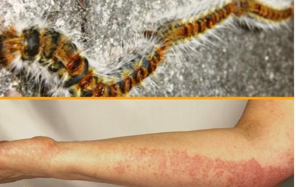 Processionary caterpillar bite symptoms and what to do