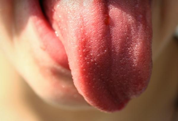 Why pimples come out on the tongue - here the answer